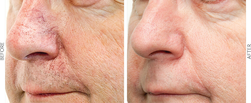 BBL Photofacial before and after image