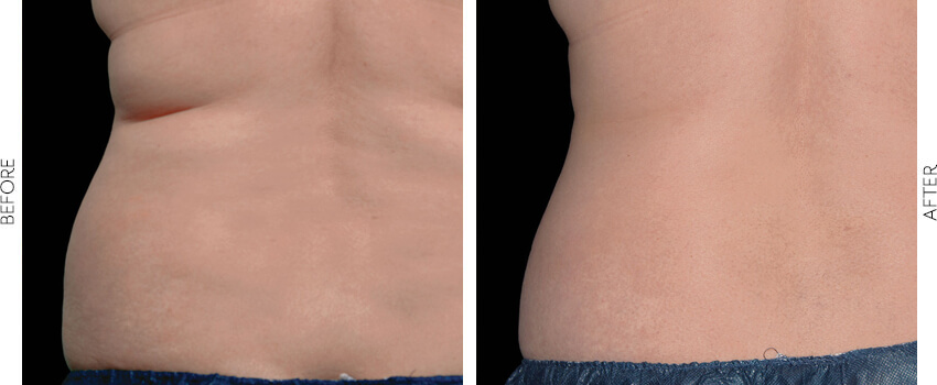 coolsculpting before and after image