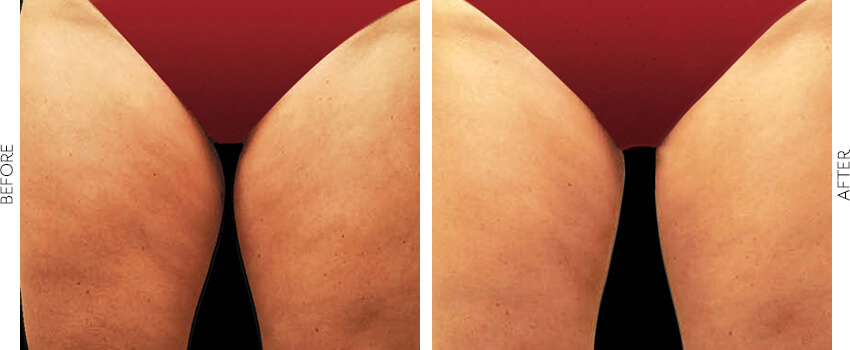 coolsculpting before and after image