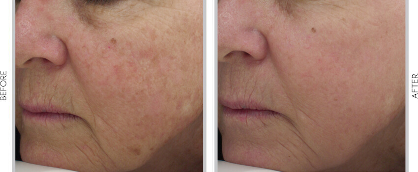 Halo Laser treatment before and after image
