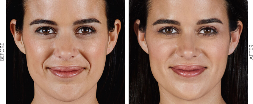 dermal fillers before and after image