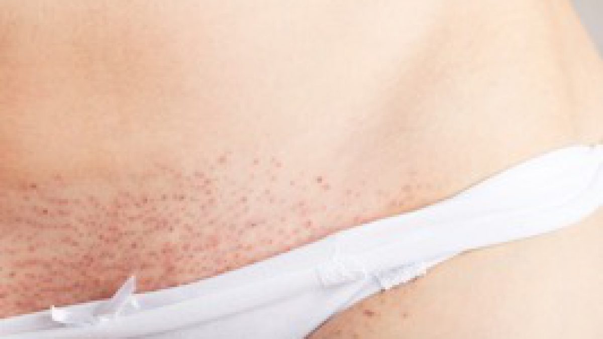 The Truth About Laser Hair Removal | Belle Marin