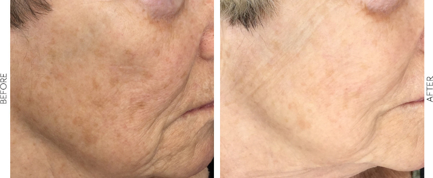 BBL Photofacial before and after image