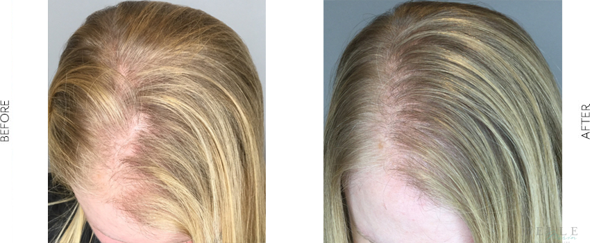 PRP hair restoration before and after image