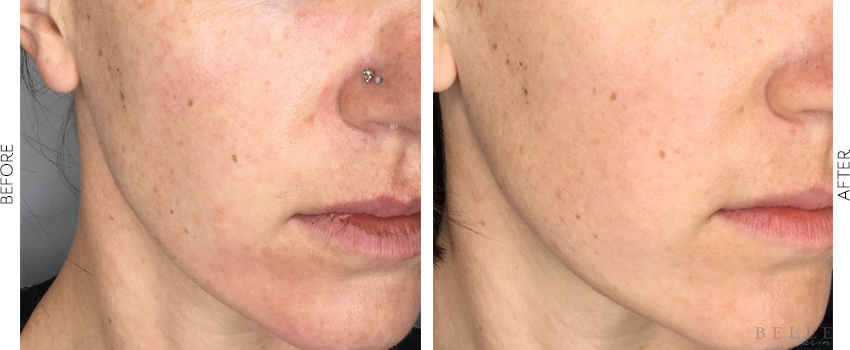 microneedling before and after image
