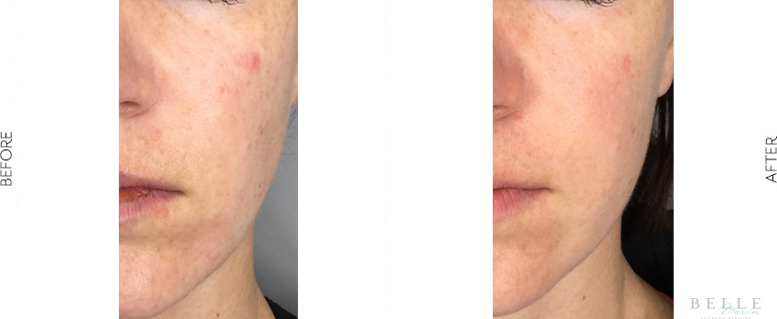 microneedling before and after image