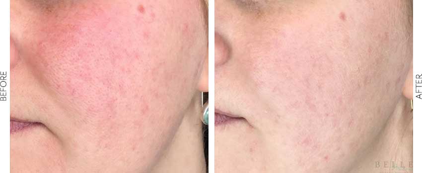 bbl photofacial before and after