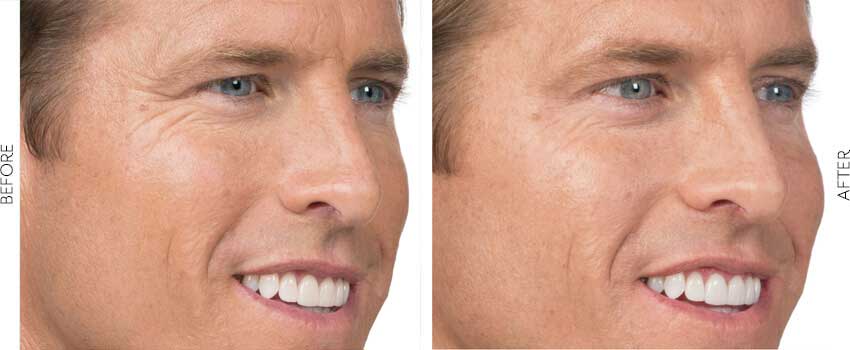 Man's face before and after Botox