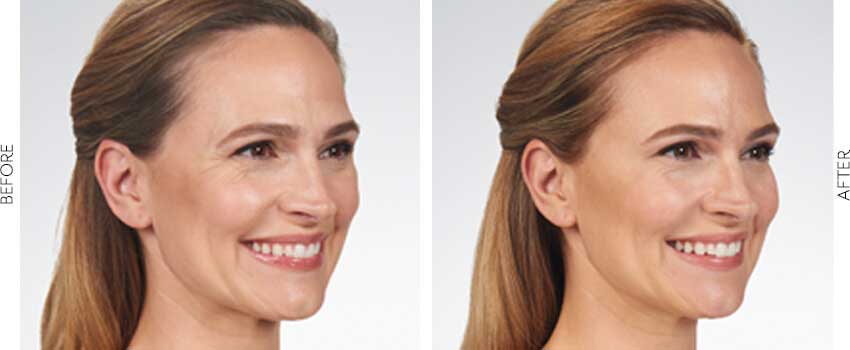 Woman's face before and after Botox