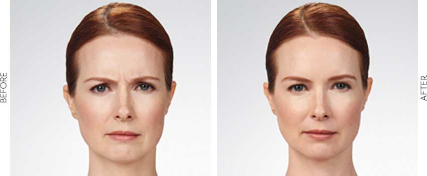 Woman's face before and after Botox