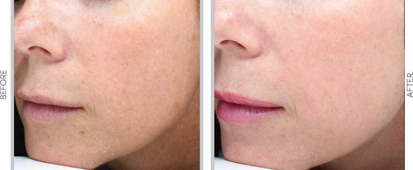 Patient's skin before and after Halo