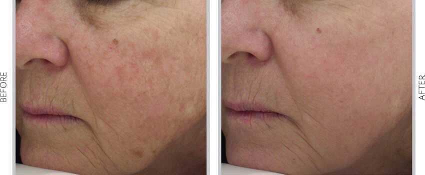 Patient's skin before and after Halo
