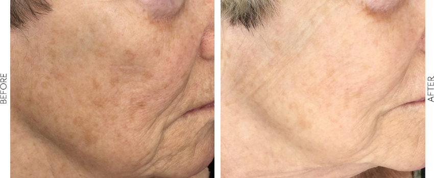 Before and After Image: BBL - right-front-oblique
