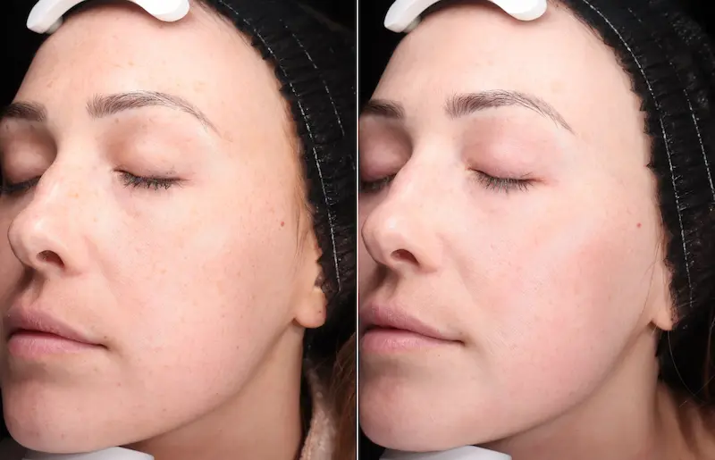 Before and After Image: BBL - left-front-oblique