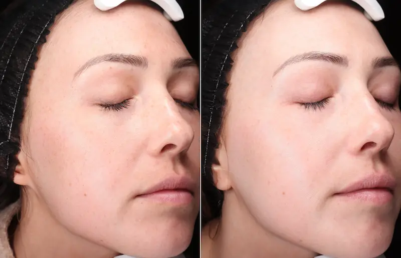 Before and After Image: BBL - right-front-oblique