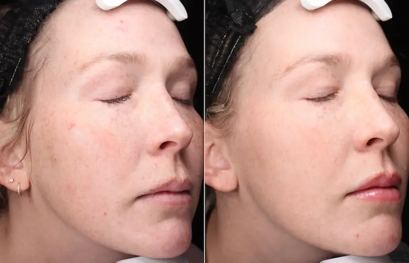 Before and After Image: BBL - right-front-oblique