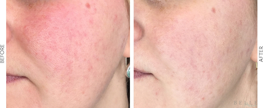 Before and After Image: BBL - left-front-oblique