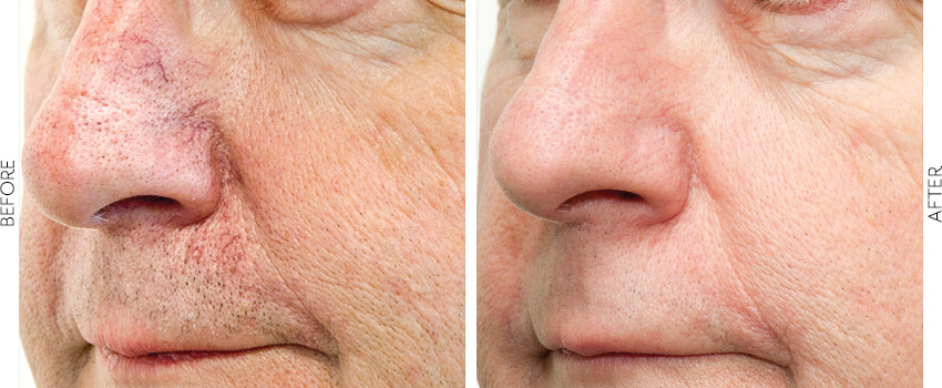 Before and After Image: BBL - left-front-oblique