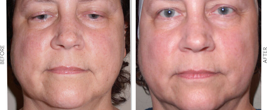 Before and After Image: BBL - front