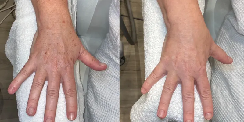 Before and After Image: BBL - front