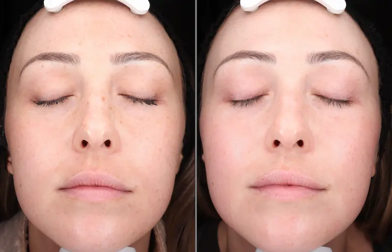 Before and After Image: BBL - front