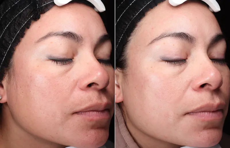 Before and After Image: BBL - right-front-oblique