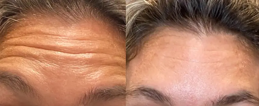 Before and After Image: Botox - front
