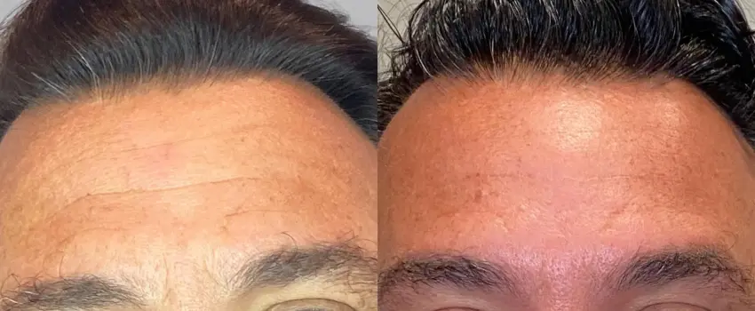 Before and After Image: Botox - front