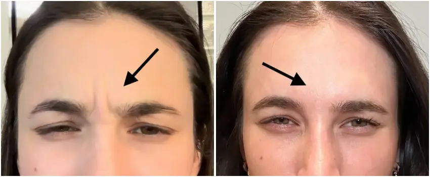 Before and After Image: Botox - front