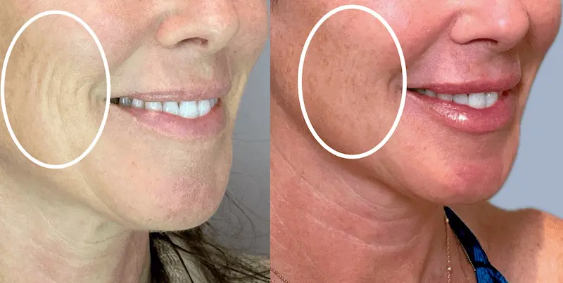 Before and After Image: Dermal Filler - right-front-oblique