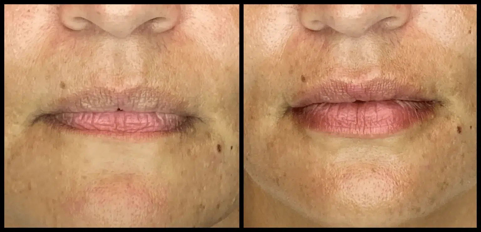 Before and After Image: Dermal Filler - front