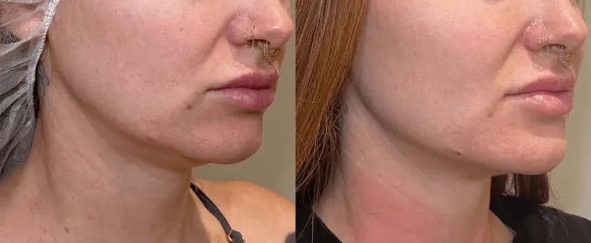 Before and After Image: Dermal Filler - right-front-oblique