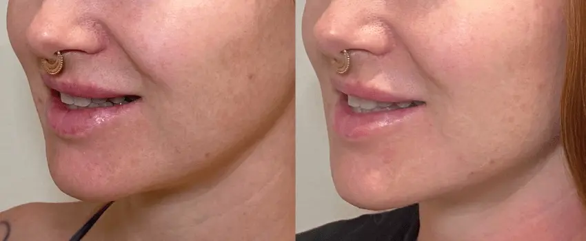 Before and After Image: Dermal Filler - left-front-oblique