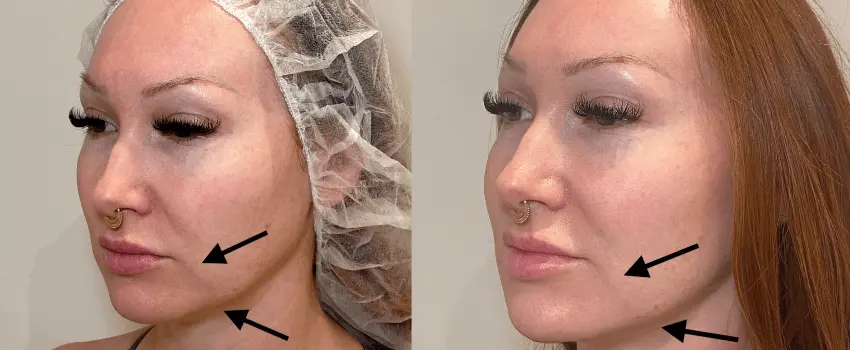 Before and After Image: Dermal Filler - left-front-oblique