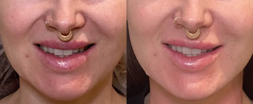Before and After Image: Dermal Filler - front