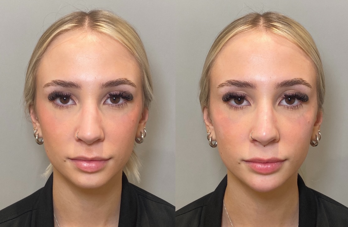 Before and After Image: Dermal Filler - front