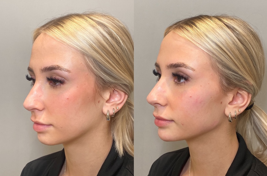 Before and After Image: Dermal Filler - left-front-oblique