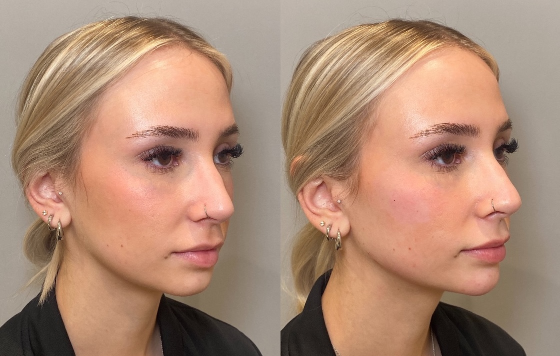 Before and After Image: Dermal Filler - right-front-oblique