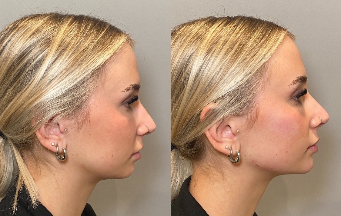 Before and After Image: Dermal Filler - right-side