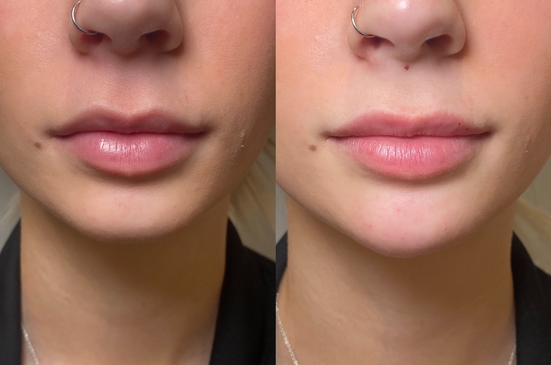 Before and After Image: Dermal Filler - front