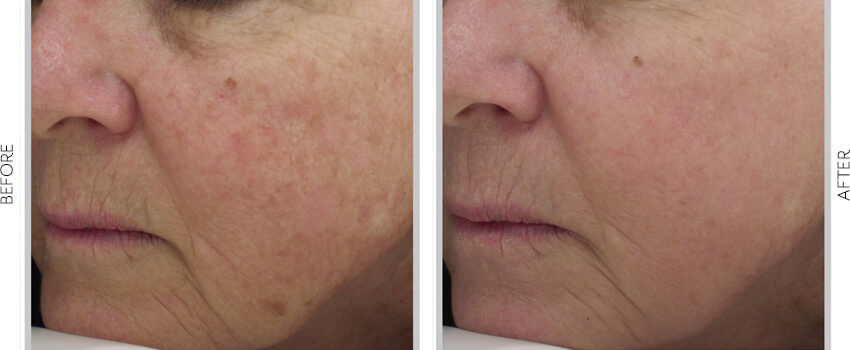 Before and After Image: Halo Laser Skin Renewal - left-front-oblique