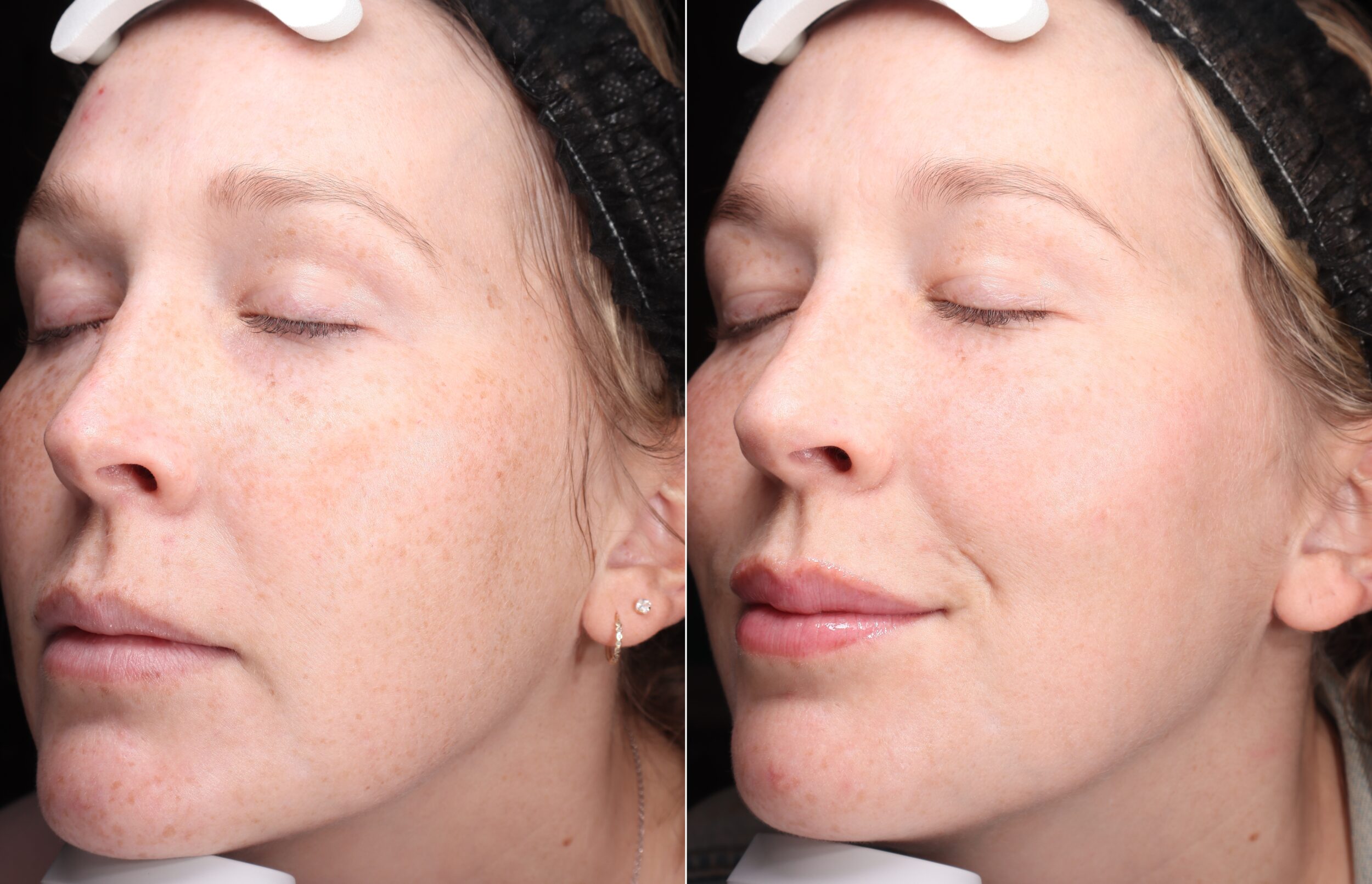 Before and After Image: Hero BBL - left-front-oblique