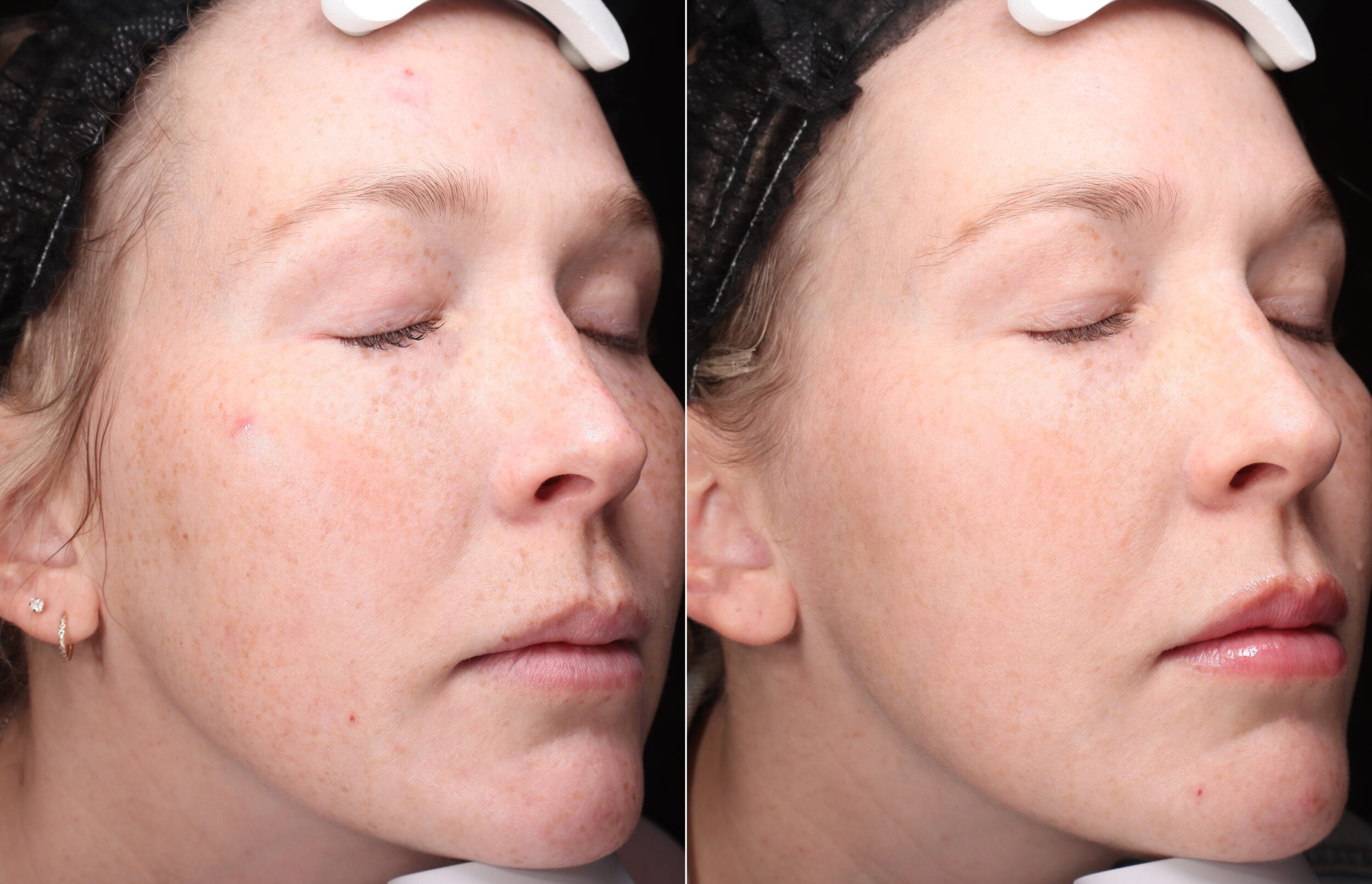 Before and After Image: Hero BBL - right-front-oblique