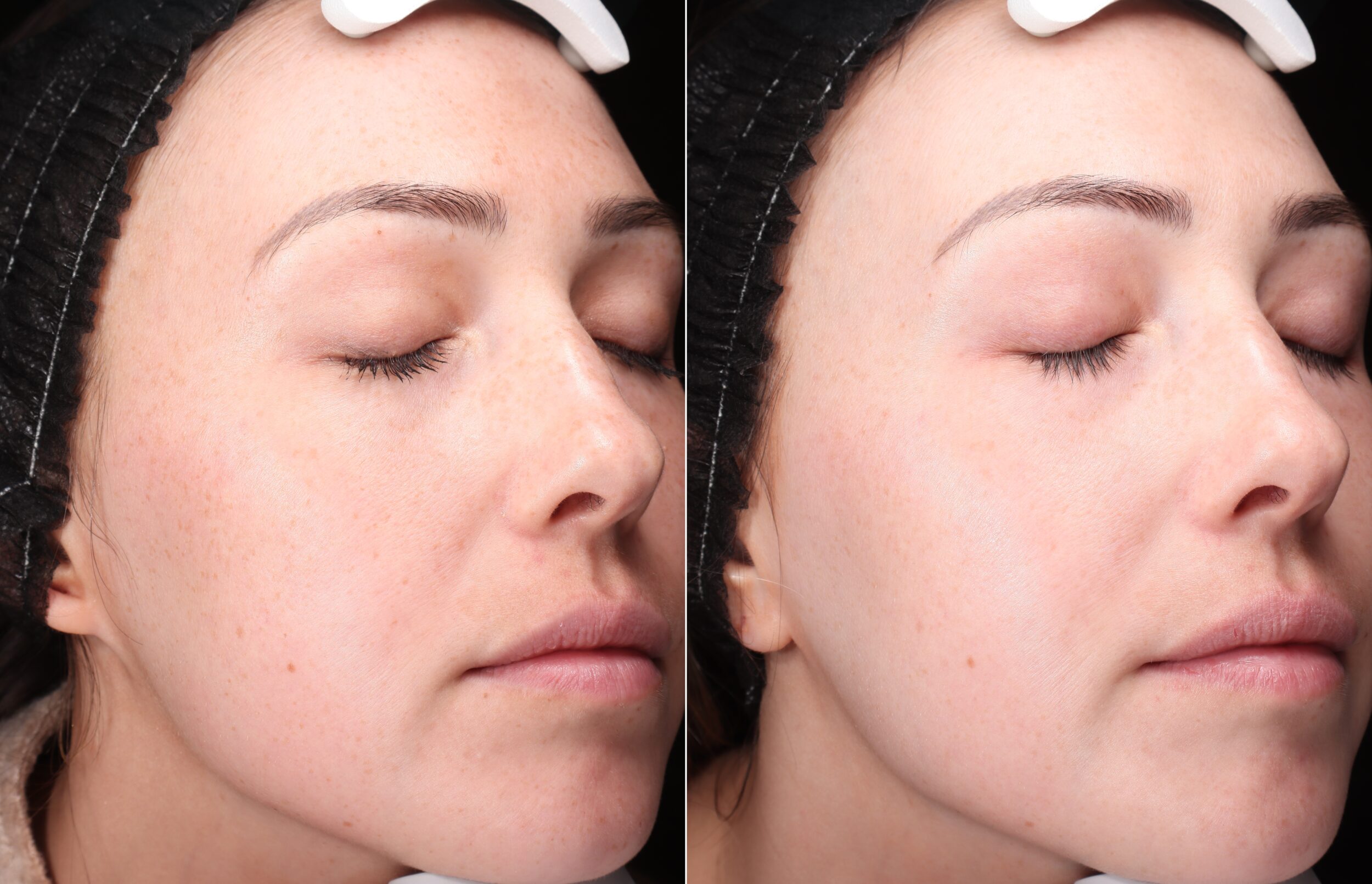 Before and After Image: Hero BBL - right-front-oblique