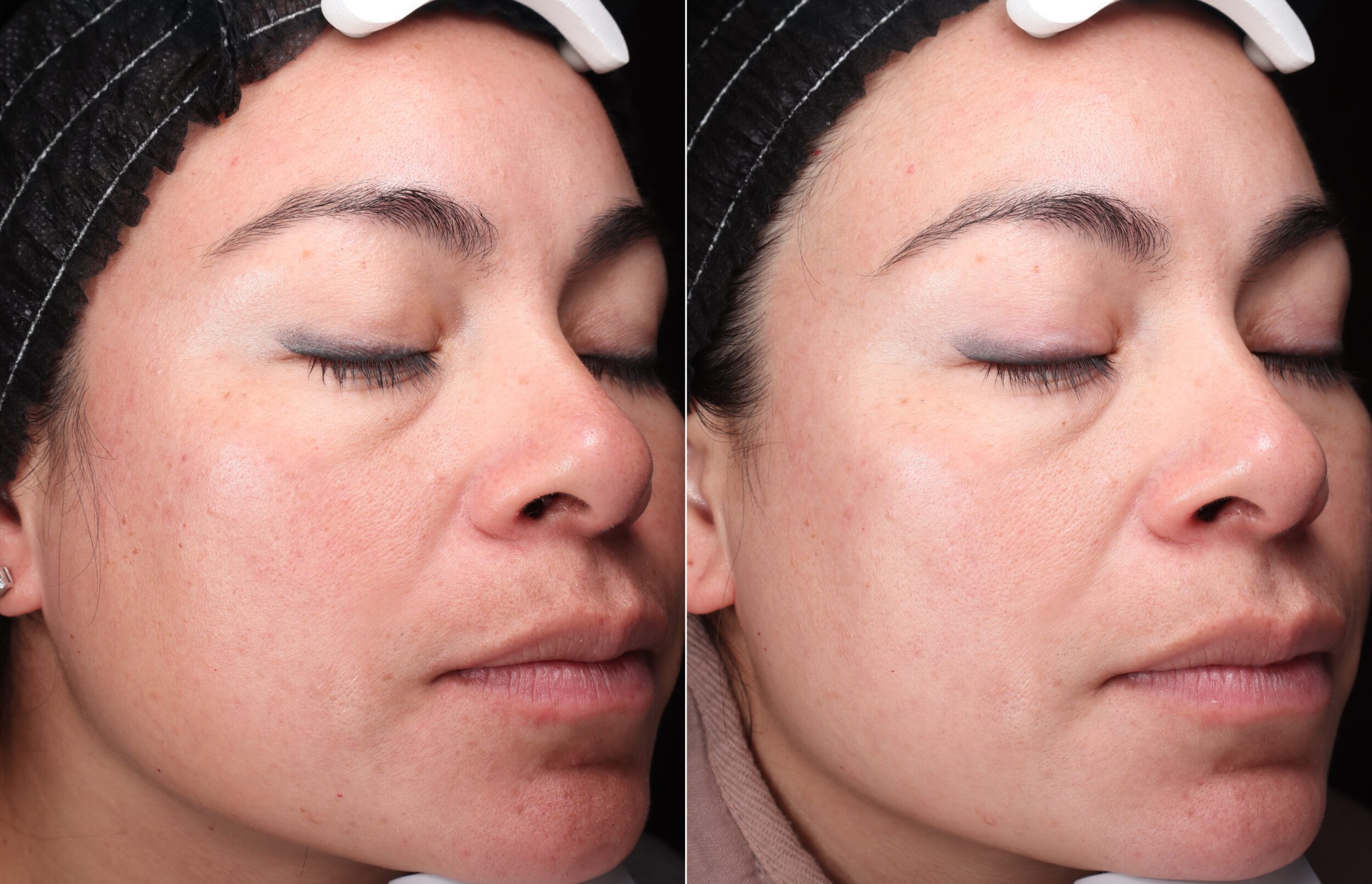 Before and After Image: Hero BBL - right-front-oblique