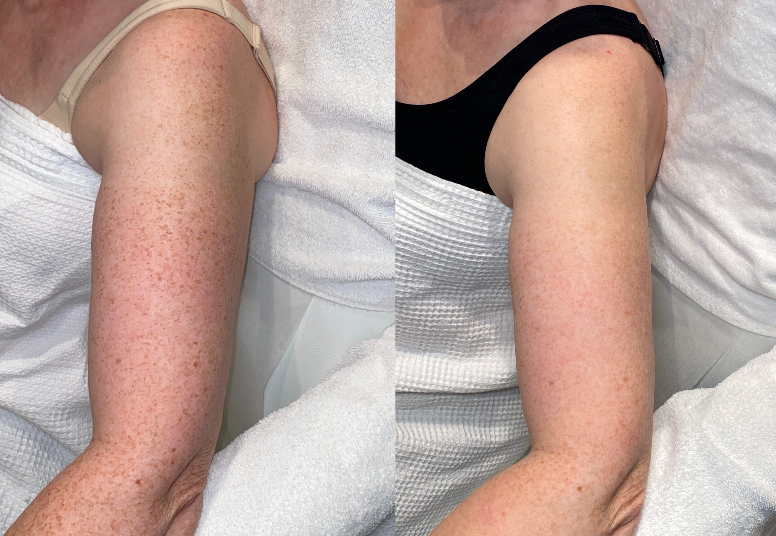 Before and After Image: Hero BBL - left-side