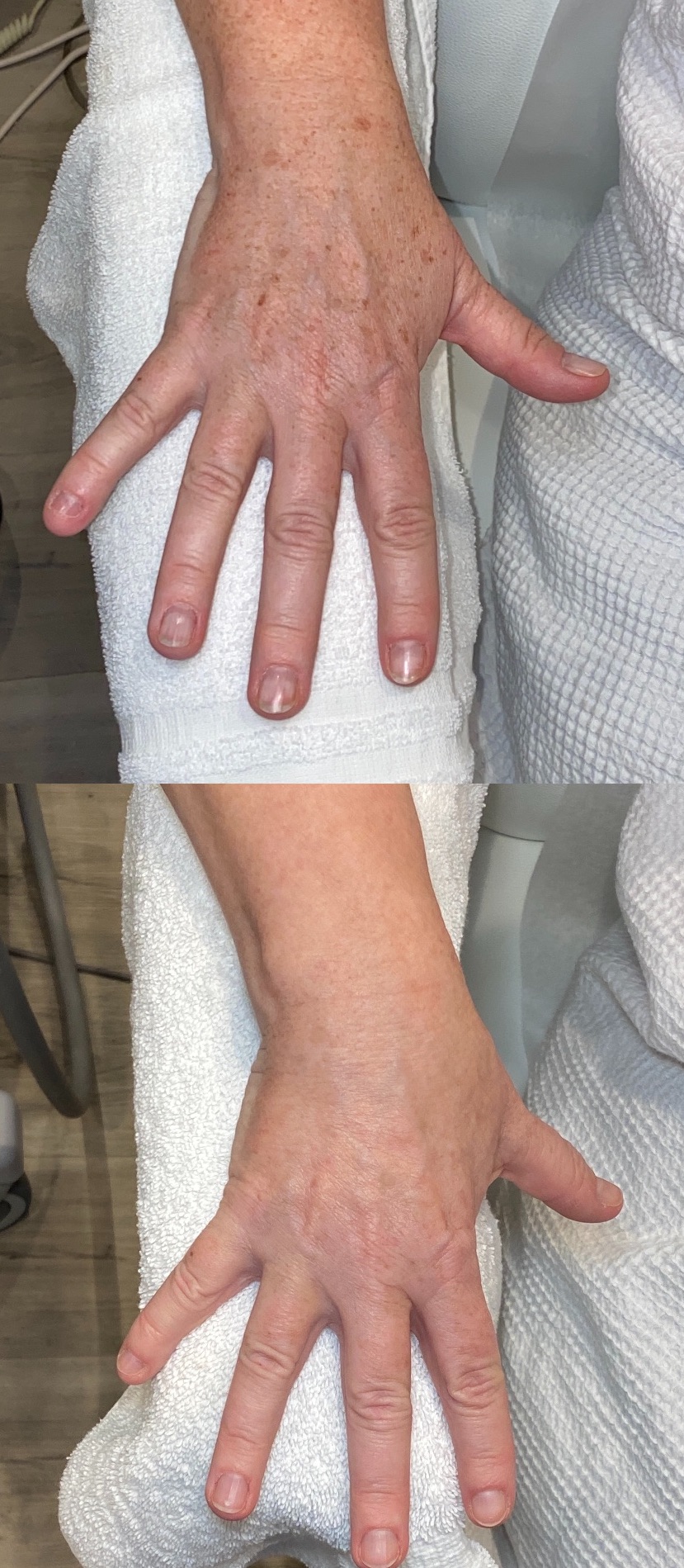 Before and After Image: Hero BBL - front