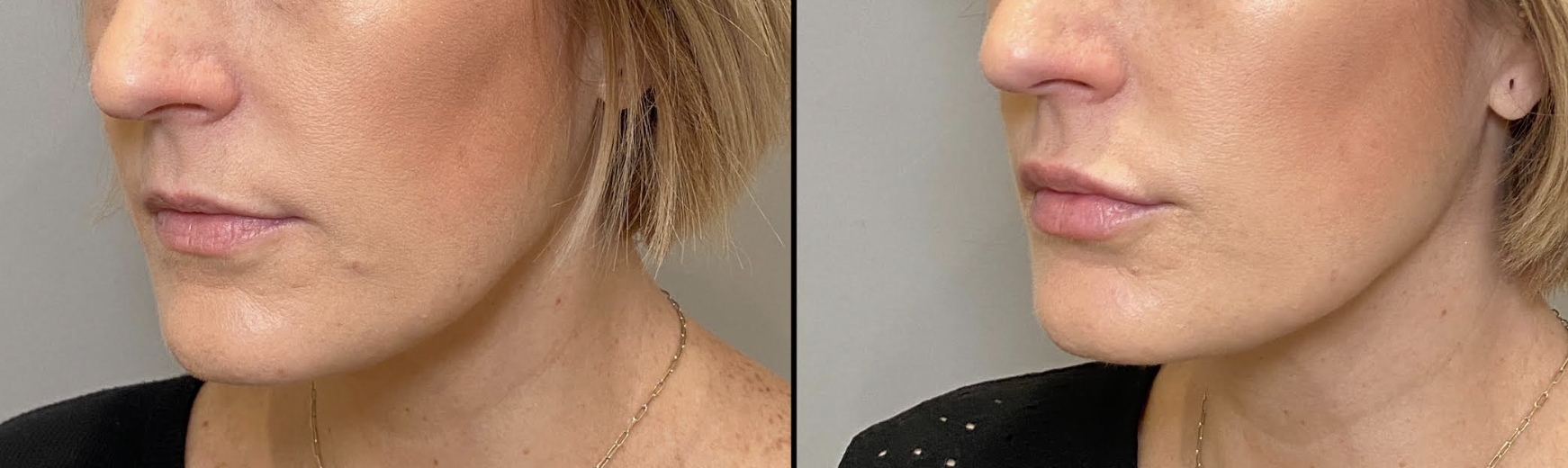 Before and After Image: Lip Filler - left-front-oblique