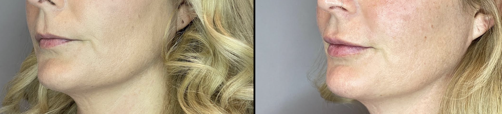 Before and After Image: Lip Filler - left-front-oblique