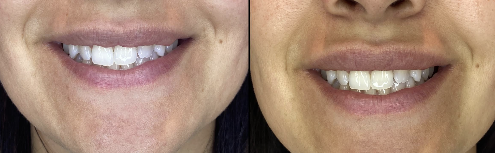 Before and After Image: Lip Filler - front